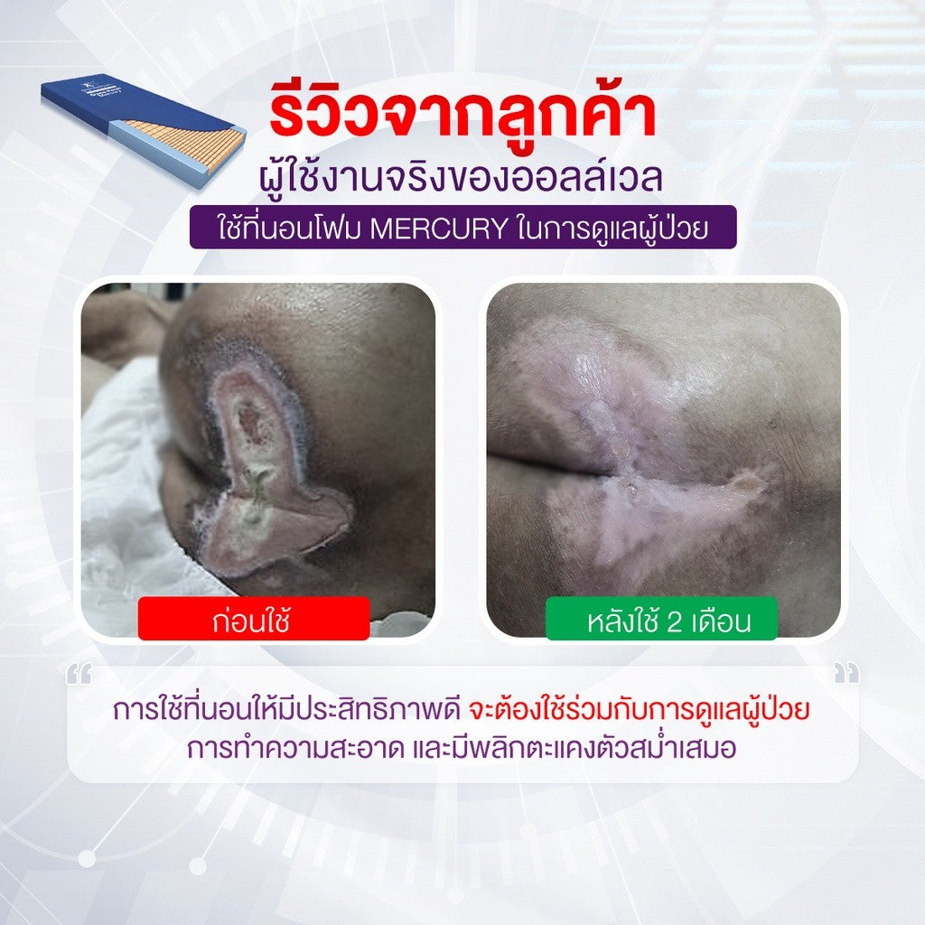 ALLWELL Pressure Foam Matress ที่นอนโฟมป้องกันแผลกดทับ ที่รพ.ใช้ รุ่น Mercury หนา 15cm ดีกว่าที่นอนลม [5 Year Warranty]